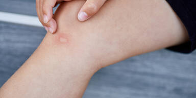 Mückenstich: Mit diesen Hausmitteln hört der Juckreiz auf
