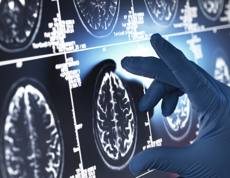 Alzheimer Medikament