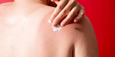 Was tun bei Sonnenbrand? Die besten SOS-Tipps für schnelle Hilfe