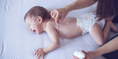 Masern-Epedemie in Serbien: 13 Tote