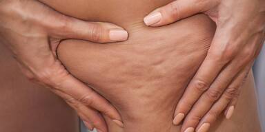 Cellulite-Revolution - Ärztin verrät: So ist Orangenhaut behandelbar