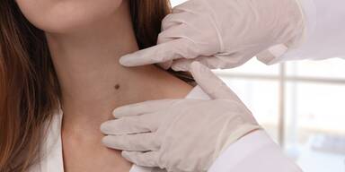 Muttermal oder Warnsignal? Wie man Hautkrebs richtig erkennt