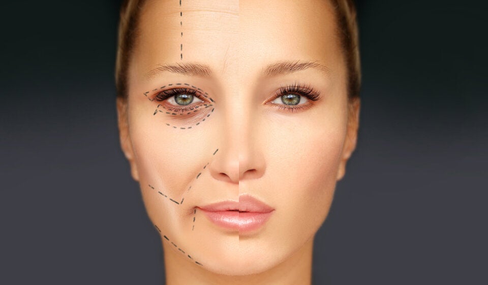 Oberlidstraffung: Behandlung von Sichtfeldeinschränkungen & dem „müden Blick“