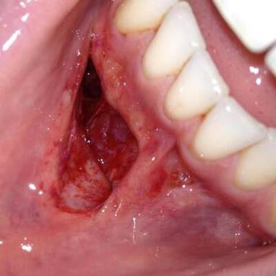 Gaumenriss Fabian Giefer