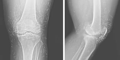 Ärzte finden Gold im Knie einer 65-Jährigen