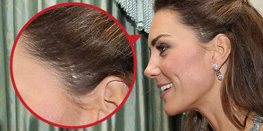 Kate MIDDLETON / Narbe