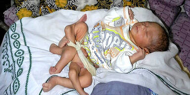 Ärzte operierten Baby mit sechs Beinen