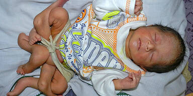 Ärzte operierten Baby mit sechs Beinen