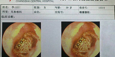 Spinne nistet 5 Tage in Ohr von Chinesin