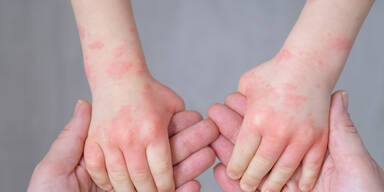 Tomatengrippe: Forscher entdecken neues Virus bei Kindern