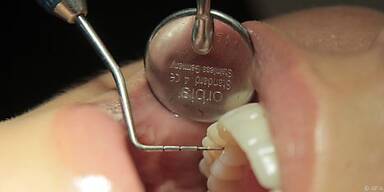 Hoffnung auf schonende Kariesbehandlung