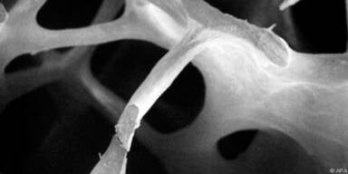 Junge Menschen k&ouml;nnen Osteoporose haben