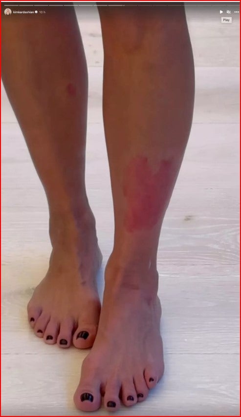 Immer wieder teilt Kim Kardashian auf sozialen Medien Bilder oder Videos von ihrer Haut. Sie findet die entzündete Hautstelle sieht diesmal aus wie ein Herz. 