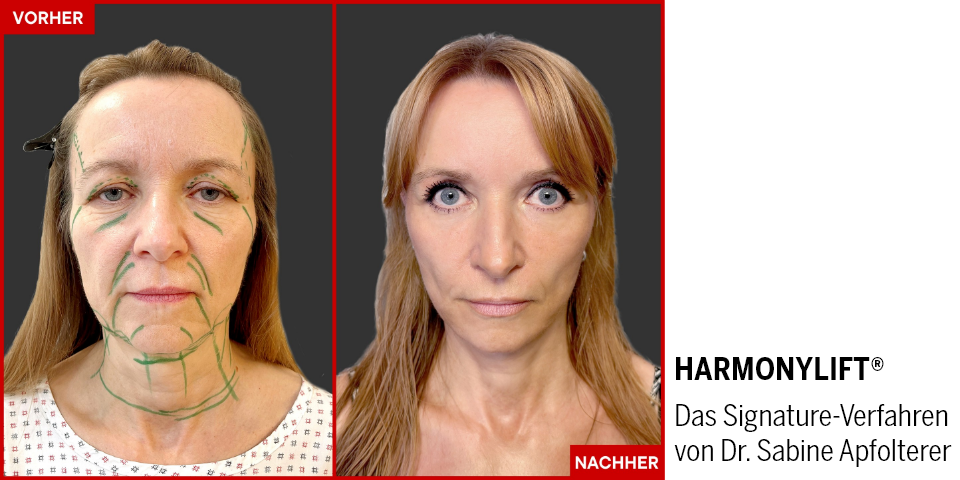 Harmonylift® – natürlich verjüngt statt sichtbar verändert