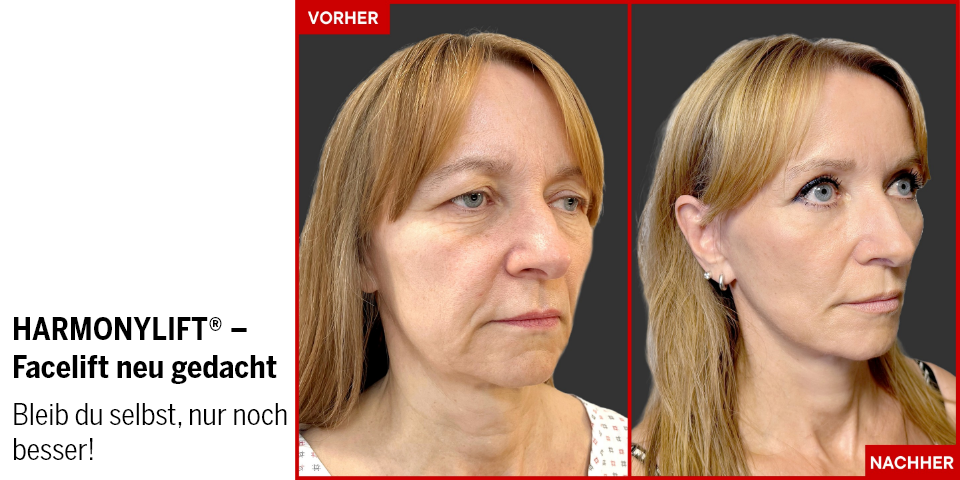 Harmonylift® – natürlich verjüngt statt sichtbar verändert