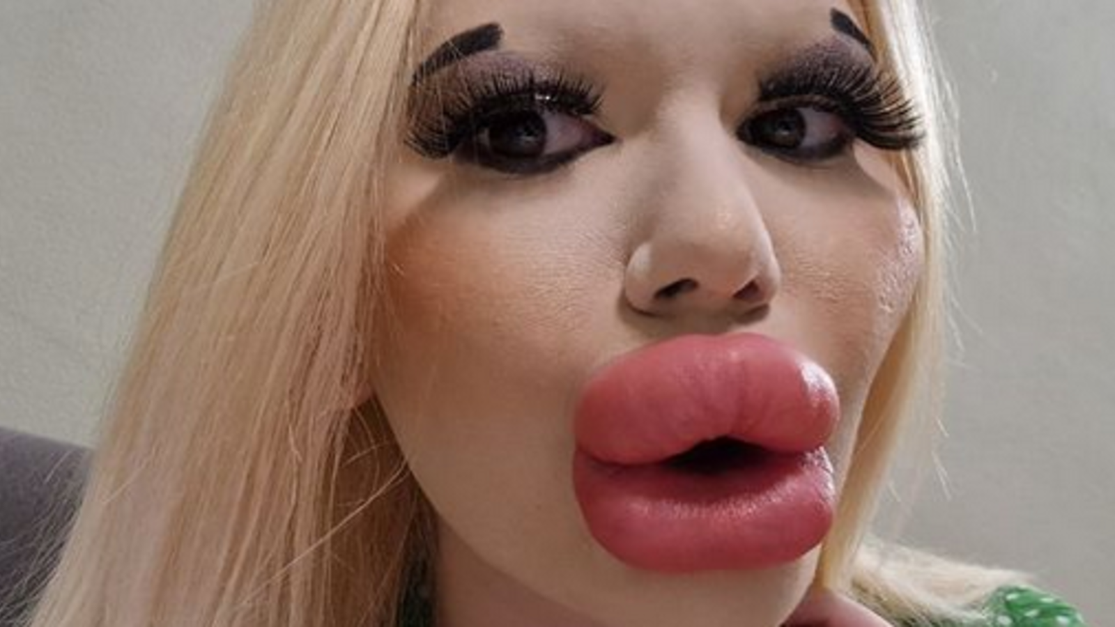 Frau mit dicksten Lippen der Welt klagt über fehlendes Liebesleben ...