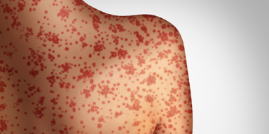 Bereits &uuml;ber 500 registrierte Masern-F&auml;lle heuer in &Ouml;sterreich