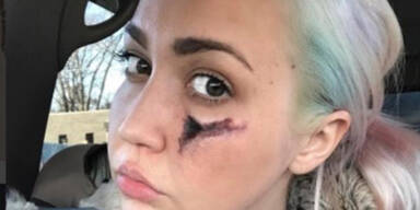 Meghan Linsey Spinnenbiss