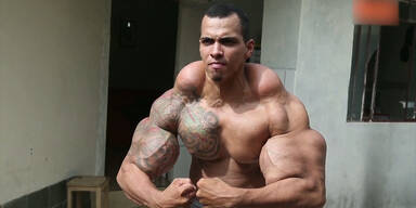 Bodybuilder wurden fast Arme amputiert