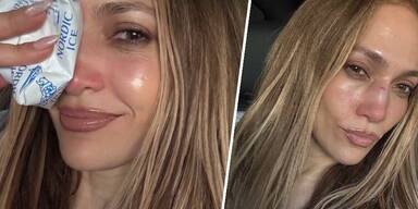 Jennifer Lopez verletzte sich an der Nase.