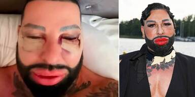 Harald Gl&ouml;&ouml;ckler schockt mit geschwollenen Augen.&nbsp;