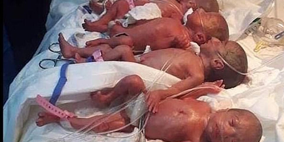 Neunlingsgeburt: Mutter schwebte in Lebensgefahr