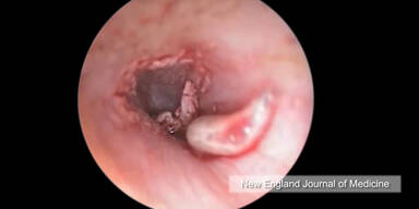 Schockierendes Video: Wurm lebt in Ohr