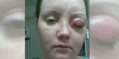 Parasit in Linse: Mutter (38) blind, glatzk&ouml;pfig und gel&auml;hmt