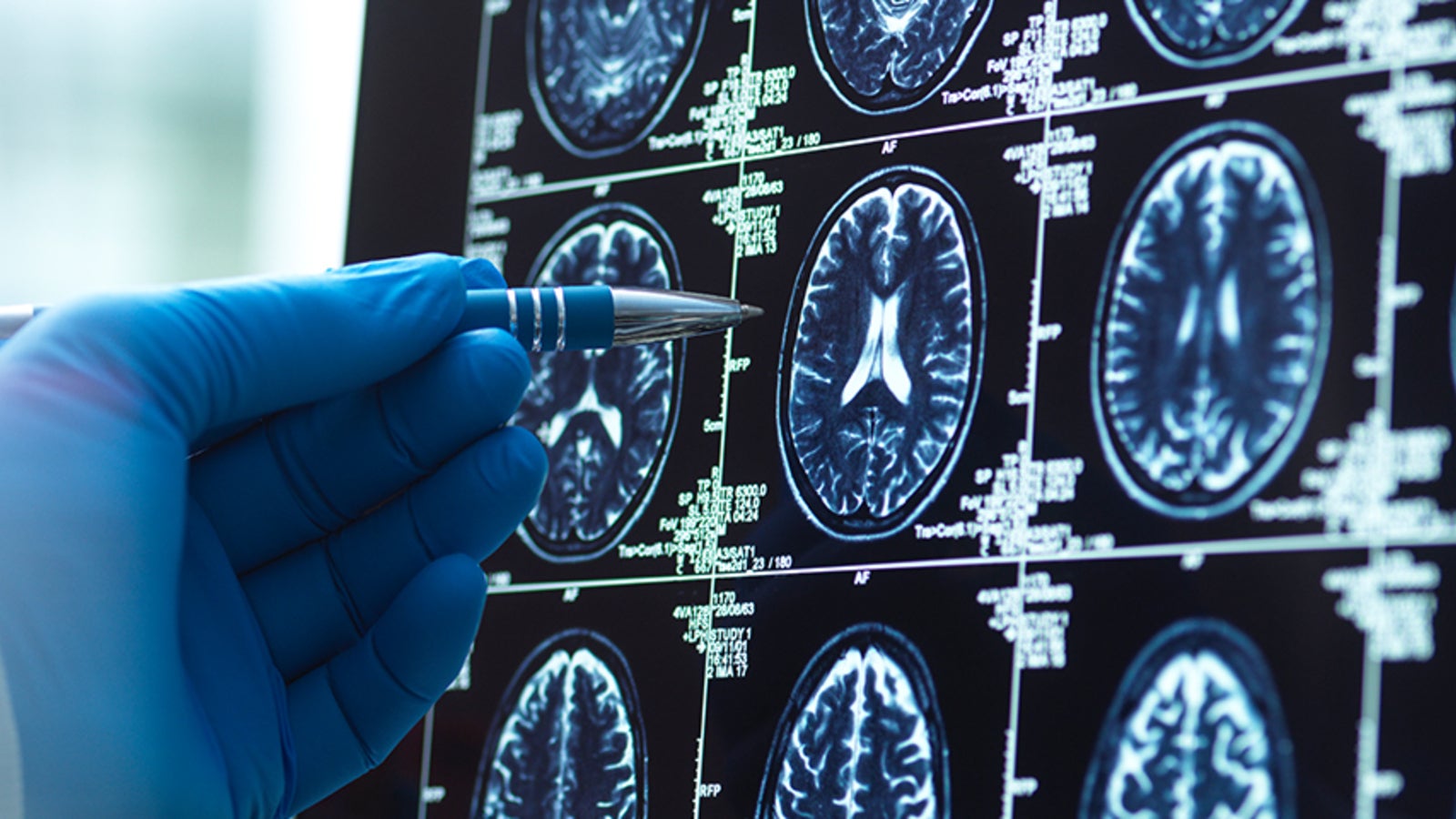 Les chercheurs célèbrent la percée dans la recherche de Parkinson