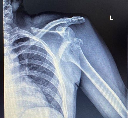 Gebrochen und ausgekugelt! Das Röntgenbild nach dem Sturz von ÖSV-Dame Marie-Therese Sporer.