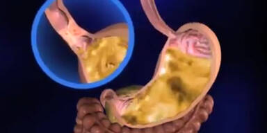 Volkskrankheit Reflux