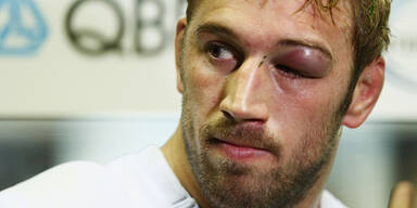 Schock-Bild! So schmerzhaft kann Rugby sein