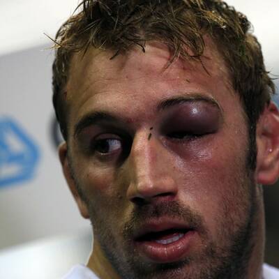 So schmerzhaft kann Rugby sein