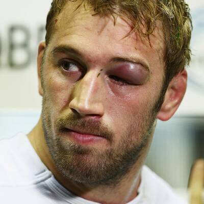 So schmerzhaft kann Rugby sein