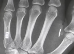 Wiener lässt sich Autoschlüssel implantieren