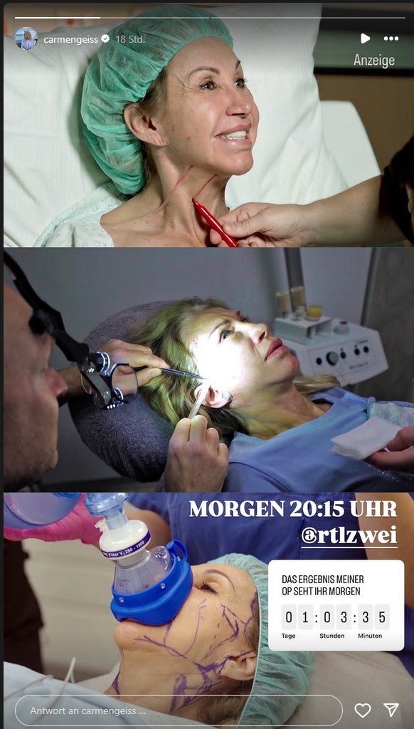 Horror-Bilder: Carmen Geiss zeigt neues Gesicht um 22.000 Euro