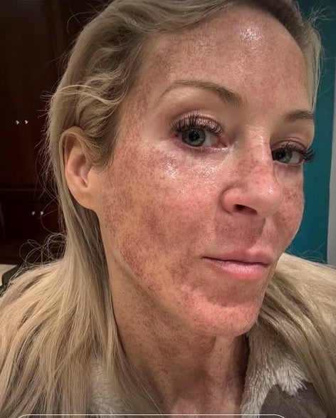 Simone Lugner zeigt sich nach der Behandlung.