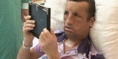 Erster Blick nach Gesichtstransplantation