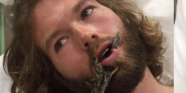 Ast pfählt Gesicht von Skilehrer