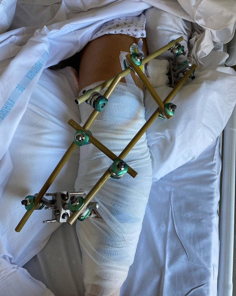 Skifahrerin Stefanie Fleckenstein postet Horror-Verletzung