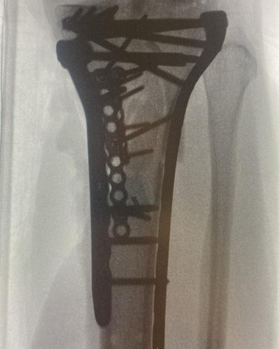 Skifahrerin Stefanie Fleckenstein postet Horror-Verletzung