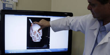 Eisenstange durch Kopf – Bauarbeiter überlebt!