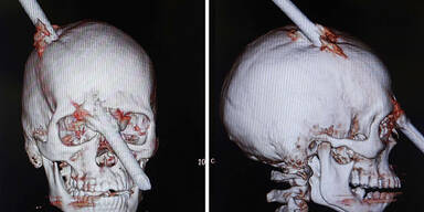 Eisenstange durch Kopf – Bauarbeiter überlebt!