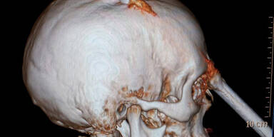 Eisenstange durch Kopf – Bauarbeiter überlebt!