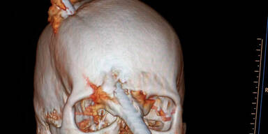 Eisenstange durch Kopf – Bauarbeiter überlebt!