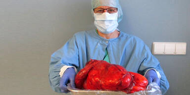 Ärzte entfernen riesigen Bauchtumor
