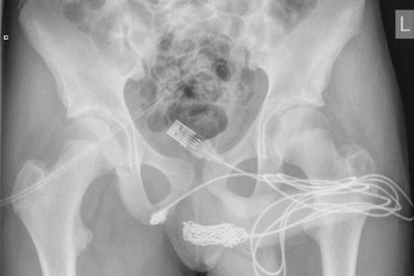 Urology Case Reports