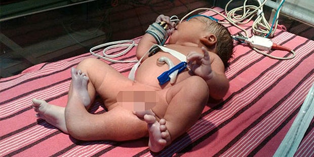 Baby mit drei Füßen