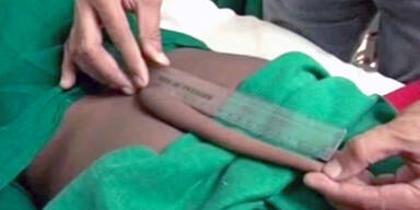 Ärzte entfernen Mann 18-Zentimeter-Schwanz