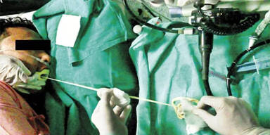 Ärzte ziehen 2-Meter-Bandwurm aus Mund eines Mannes